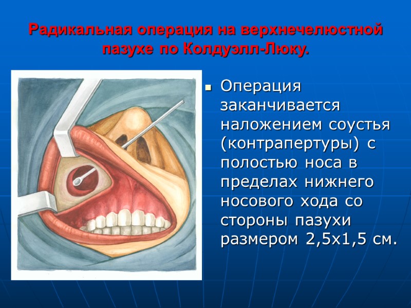 Радикальная операция на верхнечелюстной пазухе по Колдуэлл-Люку. Операция заканчивается наложением соустья (контрапертуры) с полостью